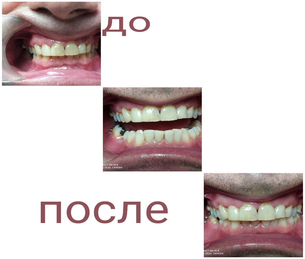 Відбілювання зубів приклад роботи