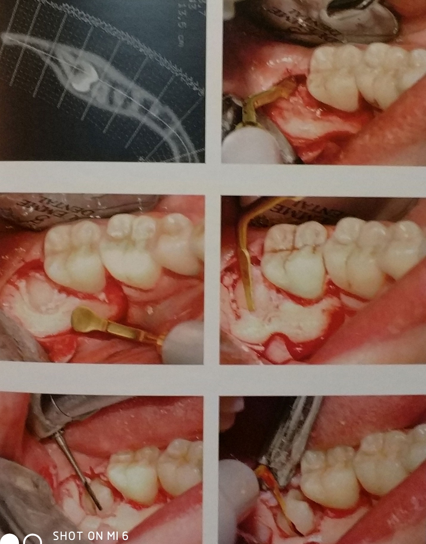 Удаление зуба ультразвуком Томск Малый хирург стоматология томск